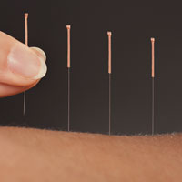 Acupuncture